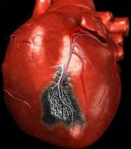 Причины разрыва сердца