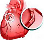 Все о ишемической болезни сердца (ИБС) - что это такое, какие симптомы и признаки, как определить и диагностировать, методы диагностики и лечения