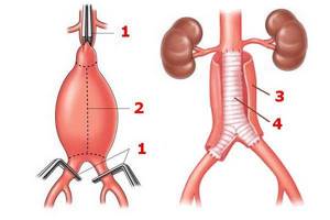 Что такое аневризма брюшной аорты: симптомы, диагностика, лечение разрыва и расслоения