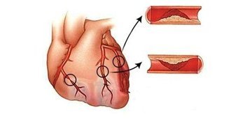 Трансмуральный инфаркт: что это такое, какие отличия на ЭКГ и чем он опасен
