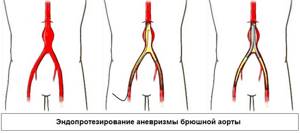 Что такое аневризма брюшной аорты: симптомы, диагностика, лечение разрыва и расслоения