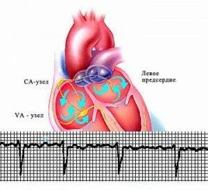 Мерцательная аритмия сердца - лечение народными средствами