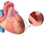 Трансмуральный инфаркт: что это такое, какие отличия на ЭКГ и чем он опасен