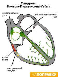 Что такое аритмия или желудочковая тахикардия типа пируэт