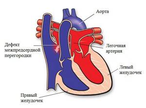 Операция при пороке сердца: стоимость, техника и показания