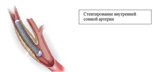 Атеросклероз сонных артерий и сосудов шеи: симптомы и лечение