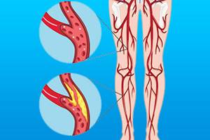 Атеросклероз сосудов нижних конечностей: симптомы, лечение, фото