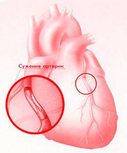 Лечение ишемической болезни сердца народными средствами и методами
