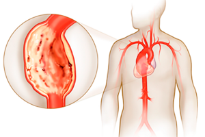 Симптомы и диагностика аневризмы грудного отдела аорты