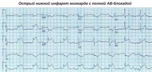 Ранние и поздние осложнения инфаркта миокарда