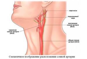 Атеросклероз сонных артерий и сосудов шеи: симптомы и лечение