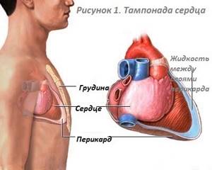 Что такое тампонада сердца
