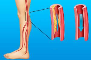 Атеросклероз сосудов нижних конечностей: симптомы, лечение, фото