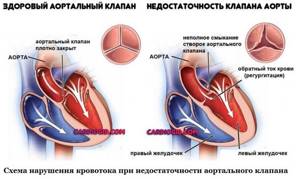 Недостаточность аортального клапана: симптомы и лечение