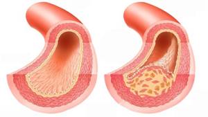 Атеросклероз коронарных артерий: описание и методы лечения
