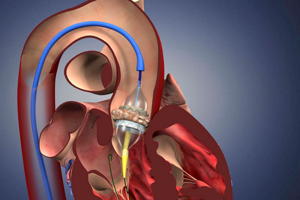 Недостаточность аортального клапана: симптомы и лечение