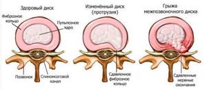 Симптомы шейного остеохондроза и ВСД: лечение и гимнастика