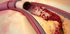 Атеросклероз коронарных артерий: описание и методы лечения