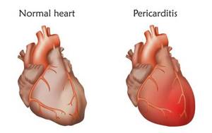 Экссудативный перикардит: откуда берется жидкость в сердце