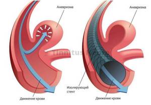 Что такое аневризма сонной артерии и как ее лечат