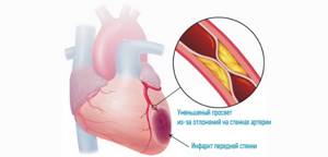 Хроническая форма ишемической болезни сердца - что это такое, какие типы существуют