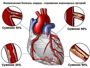 Сколько живут после инфаркта: статистика и прогноз
