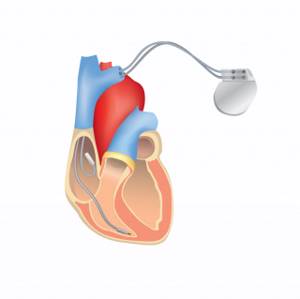Аритмии (нарушения сердечного ритма) - симптомы, виды и классификация, диагностика