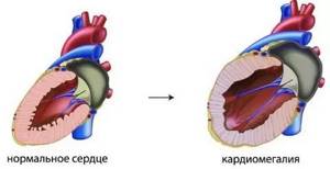 Бычье сердце у человека (кардиомегалия) – причины болезни и лечение синдрома