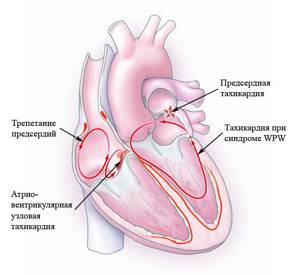 Тахикардия (учащенное сердцебиение, тахиаритмия): причины, симптомы, лечение и борьба с приступом