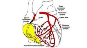 Инфаркт задней стенки сердца: особенности, последствия и прогноз