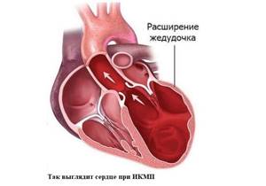 Ишемическая кардиомиопатия - что это такое