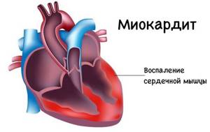 Симптомы и лечение воспаления сердечной мышцы