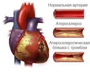 Стентирование сосудов сердца: показания, видео операции, осложнения, реабилитация и отзывы, сколько живут после