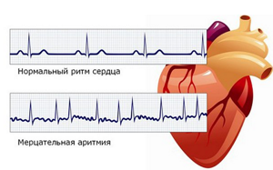 Что делать при приступе аритмии сердца - как его быстро снять