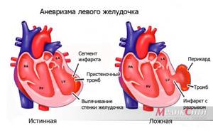 Аневризма сердца и расширение его желудочков - причины и лечение