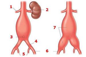 Что такое аневризма брюшной аорты: симптомы, диагностика, лечение разрыва и расслоения