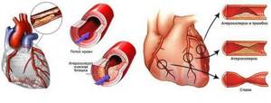 Хроническая форма ишемической болезни сердца - что это такое, какие типы существуют