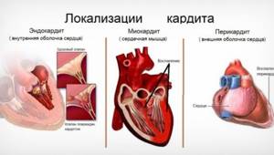 Ревмокардиты, миокардиты, перикардиты, эндокардиты и другие воспалительные патологии сердца