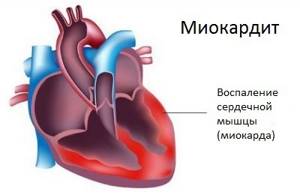 Миокардиодистрофия: виды, симптомы и лечение сердца