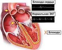 Блокады сердца (i, ii степени, полная): что это такое и как лечить